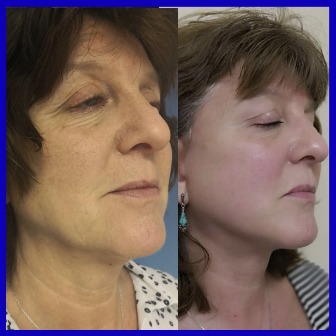 before and after deep plane facelift surgery