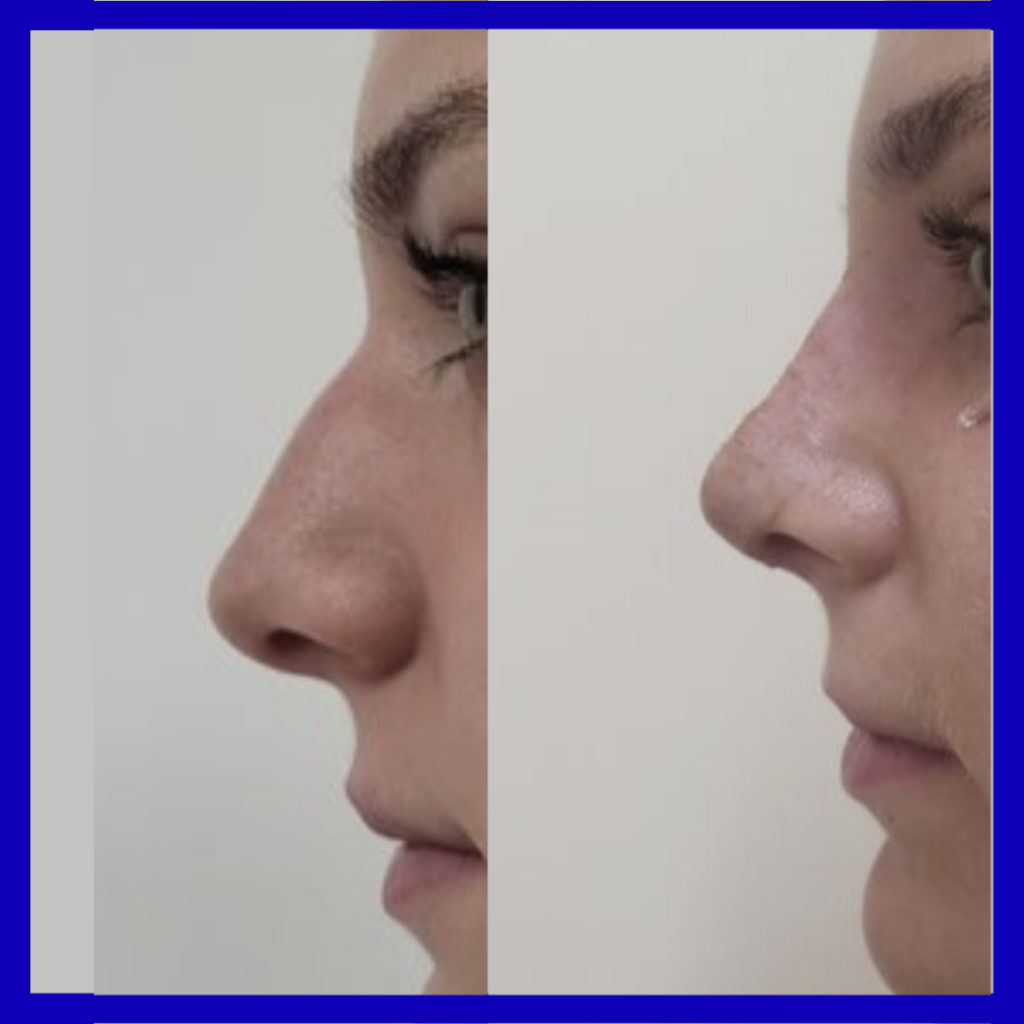 before and after rhinoplasty surgery 