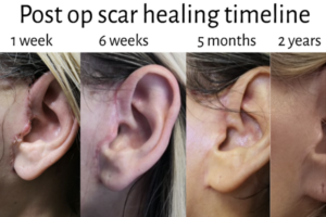 Facelift Post Op Scar Healing Timeline