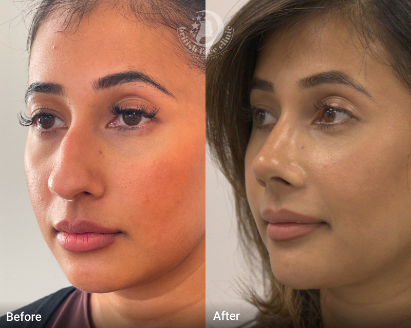 Rhinoplasty Before and After