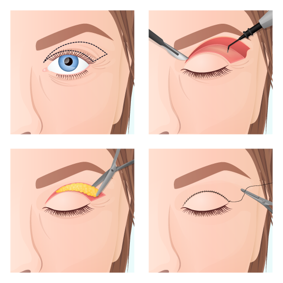 Blepharoplasty procedure