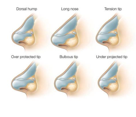 What Can We Treat With Rhinoplasty