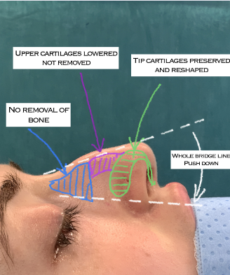 rhinoplasty london natural looking results