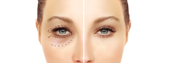 upper and lower Blepharoplasty london