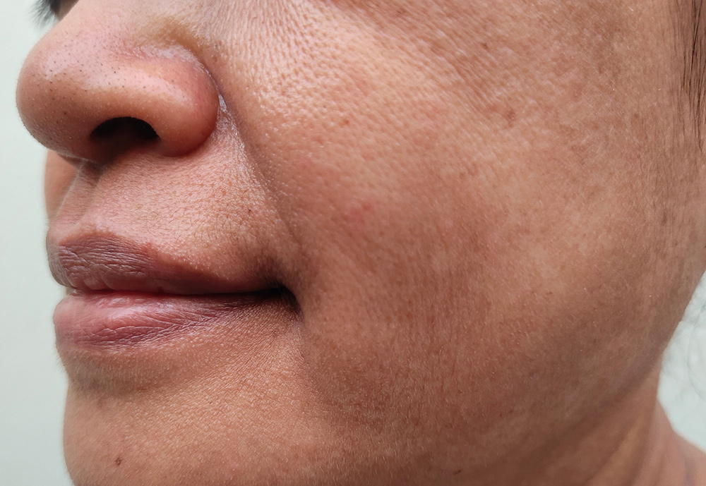 marionette lines treatment london, lower face balance, facial procedures