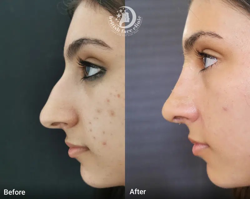 dorsal hump nose, rhinoplasty, nose reshaping surgery