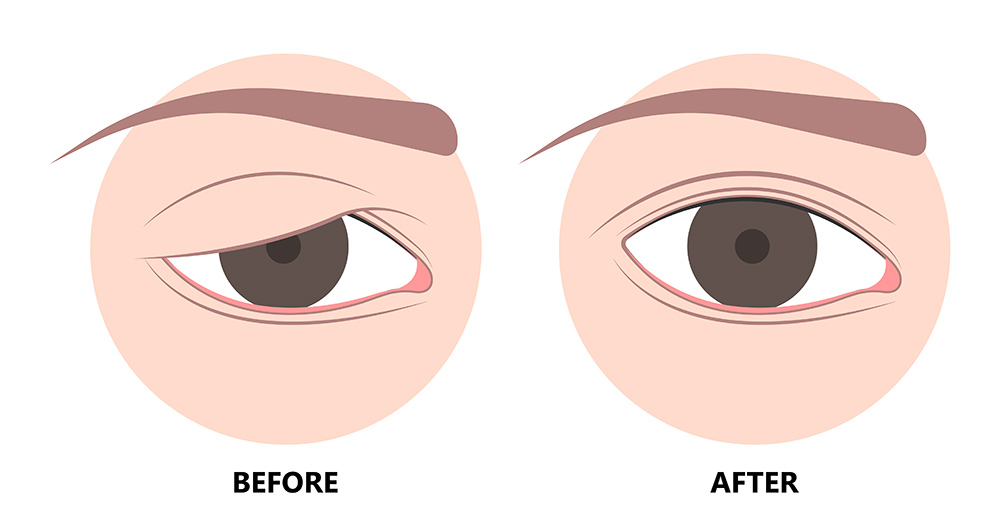 uneven eyelids treatment, eyelid contour balance, upper and lower lid symmetry