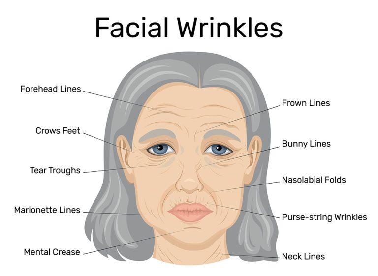 Deep Creases Types of Wrinkles Explained: Causes and Treatment Options