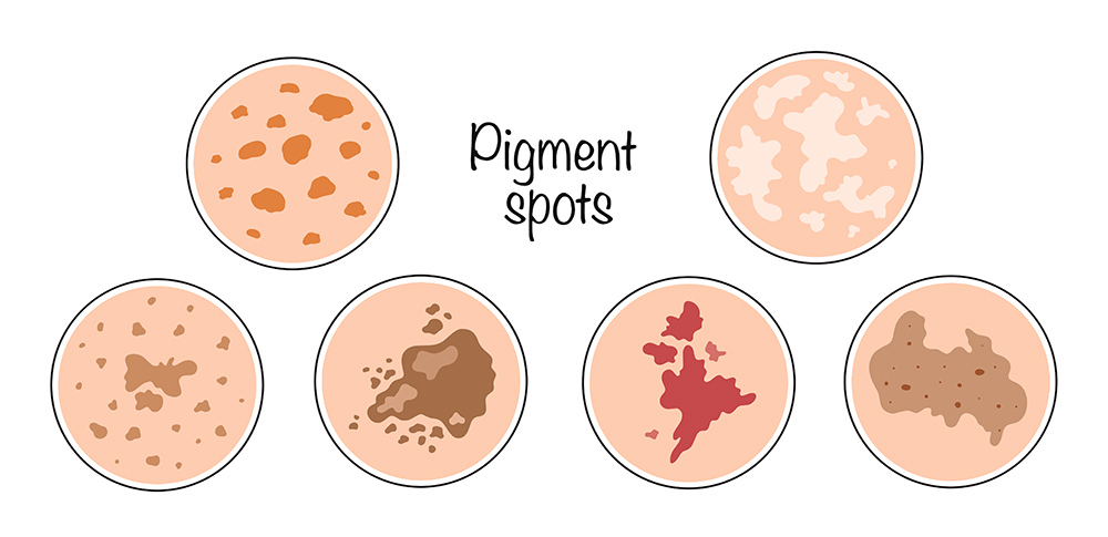 Hyperpigmentation Treatment for Uneven Skin Tone
