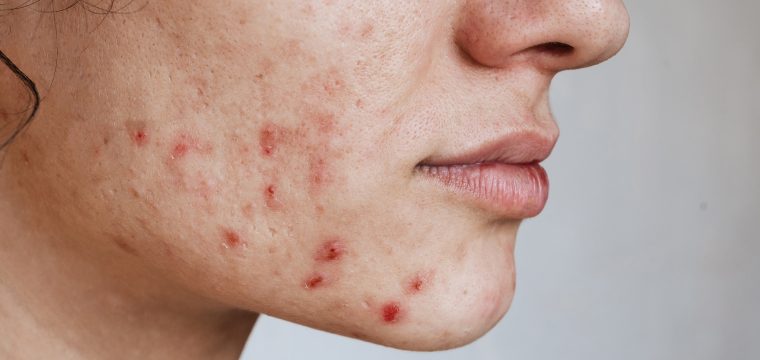 types of acne scars acne scar types acne scars treatment acne scar causes