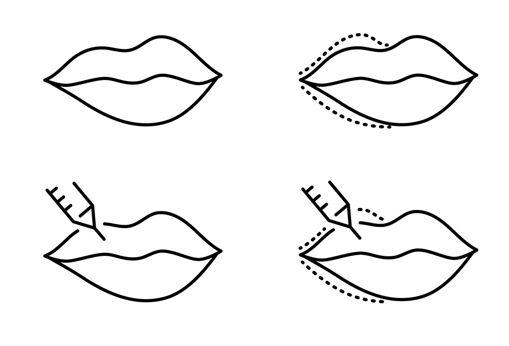 Asymmetrical Lips Treatment for Natural Lip Balance
